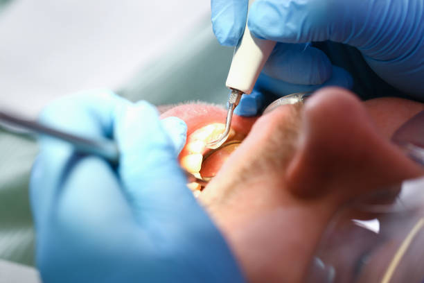 Best Emergency Treatment for Dental Infections or Abscesses in Lavallette, NJ